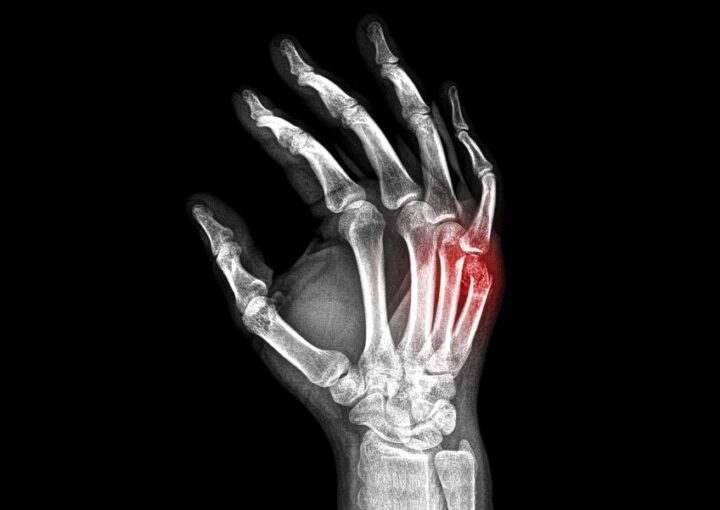 frattura quinto metacarpo